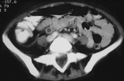 Right Hydronephrosis With Acute Pyelonephritis - CTisus CT Scan