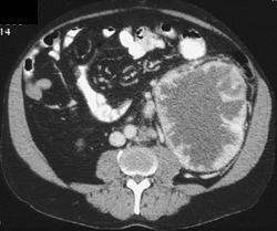 Oncocytoma - CTisus CT Scan