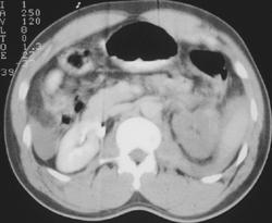 Non Functioning Left Kidney S/P Trauma - CTisus CT Scan