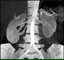 2 Right Renal Arteries With Right Ureteropelvic Junction (UPJ) - CTisus CT Scan