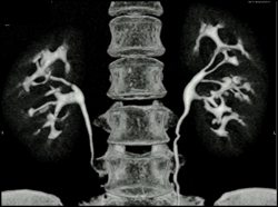 Unusual CT Urograms - CTisus CT Scan