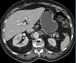 Renal Cell Carcinoma - CTisus CT Scan