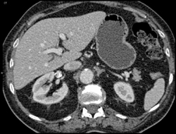 Renal Artery Aneurysm - CTisus CT Scan