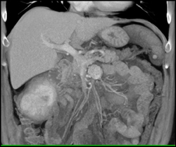 Renal Cell Carcinomas - CTisus CT Scan