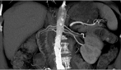 3 Renal Arteries to Each Kidney - CTisus CT Scan