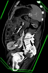 Transplanted Kidney - CTisus CT Scan