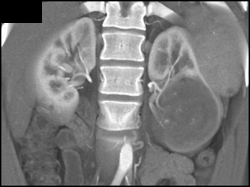 Cystic Renal Cell Carcinoma - CTisus CT Scan