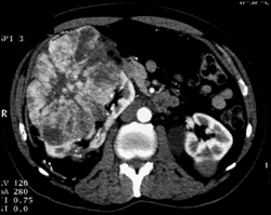 Oncocytoma - CTisus CT Scan