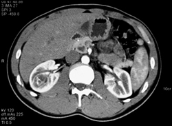Renal Cell Carcinoma and Pancreatic Cysts- Von Hippel Lindau - CTisus CT Scan
