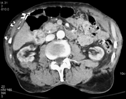 Cystic Renal Cell Carcinoma in Right Kidney - CTisus CT Scan