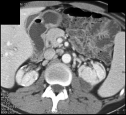 End Stage Renal Disease With Chronic Pyelonephritis - CTisus CT Scan