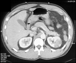 Acute Pyelonephritis - CTisus CT Scan