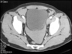 Blood in Pelvis - CTisus CT Scan