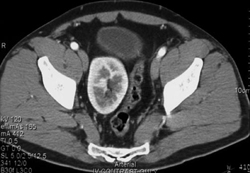 Pelvic Kidney - CTisus CT Scan