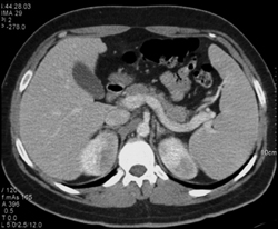 Acute Pyelonephritis - CTisus CT Scan