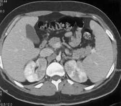 Acute Pyelonephritis - CTisus CT Scan