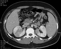 Acute Pyelonephritis - CTisus CT Scan