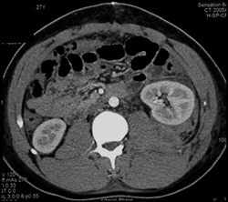 Renal Contusion With Perirenal Blood - CTisus CT Scan