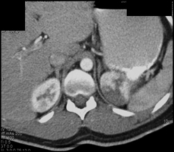 Acute Pyelonephritis - CTisus CT Scan