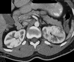 Acute Pyelonephritis - CTisus CT Scan