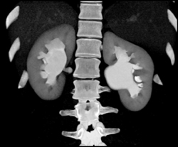 Ct Urogram-dilated Renal Pelvises Due to Bilateral Ureteropelvic Junction (UPJ) - CTisus CT Scan