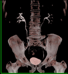 Ct Urogram - CTisus CT Scan