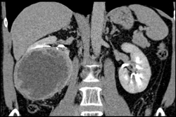 Cystic Renal Cell Carcinoma With Nodularity - CTisus CT Scan