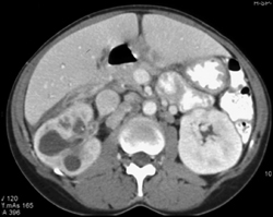 Acute Pyelonephritis With Obstructing Stone - CTisus CT Scan