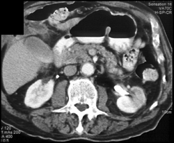 Acute Pyelonephritis in Left Kidney - CTisus CT Scan