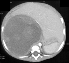 Wilms Tumor - CTisus CT Scan