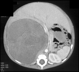 Wilms Tumor - CTisus CT Scan