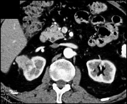 Renal Cell Carcinoma - CTisus CT Scan