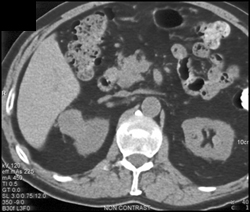 Renal Cell Carcinoma - CTisus CT Scan