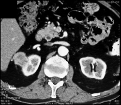 Renal Cell Carcinoma - CTisus CT Scan