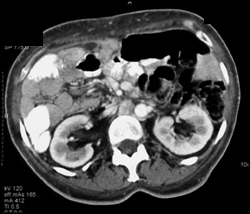 Malrotation - CTisus CT Scan