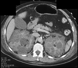 Polycystic Kidney Disease With Stones and High Density Renal Cysts - CTisus CT Scan