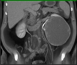 Cystic Renal Cell Carcinoma - CTisus CT Scan