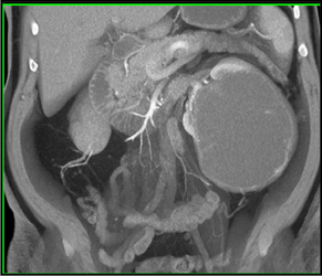 Cystic Renal Cell Carcinoma - CTisus CT Scan