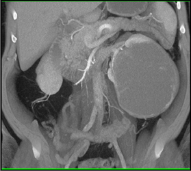 Cystic Renal Cell Carcinoma - CTisus CT Scan