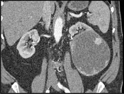 Cystic Renal Cell Carcinoma - CTisus CT Scan