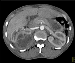 Renal Abscess - CTisus CT Scan