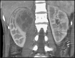 Renal Abscess - CTisus CT Scan