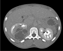 Renal Abscess - CTisus CT Scan