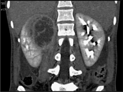 Renal Abscess - CTisus CT Scan