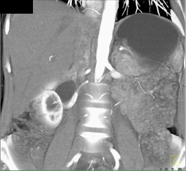 Right Renal Artery Causes A Ureteropelvic Junction (UPJ) - CTisus CT Scan