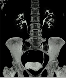 Stretched Calyces on CT Urogram - CTisus CT Scan