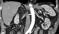 Bilateral Duplication of the Renal Artery - CTisus CT Scan