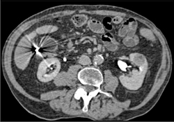 Avascular Renal Cell Carcinoma - CTisus CT Scan