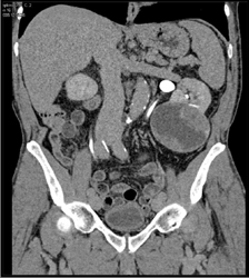 Cystic Renal Cell Carcinoma - CTisus CT Scan