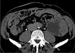 Cystic Renal Cell Carcinoma - CTisus CT Scan